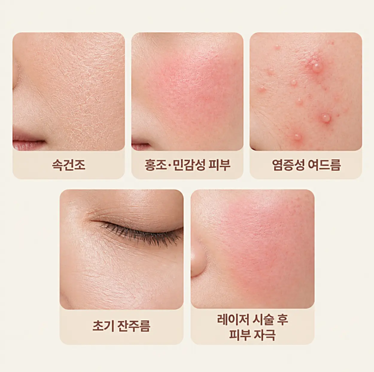 LDM이란 관리가 도움이 되는 속건조, 홍조·민감성 피부, 염증성 여드름, 초기 잔주름 및 레이저 시술 후 피부 자극 5가지 고민