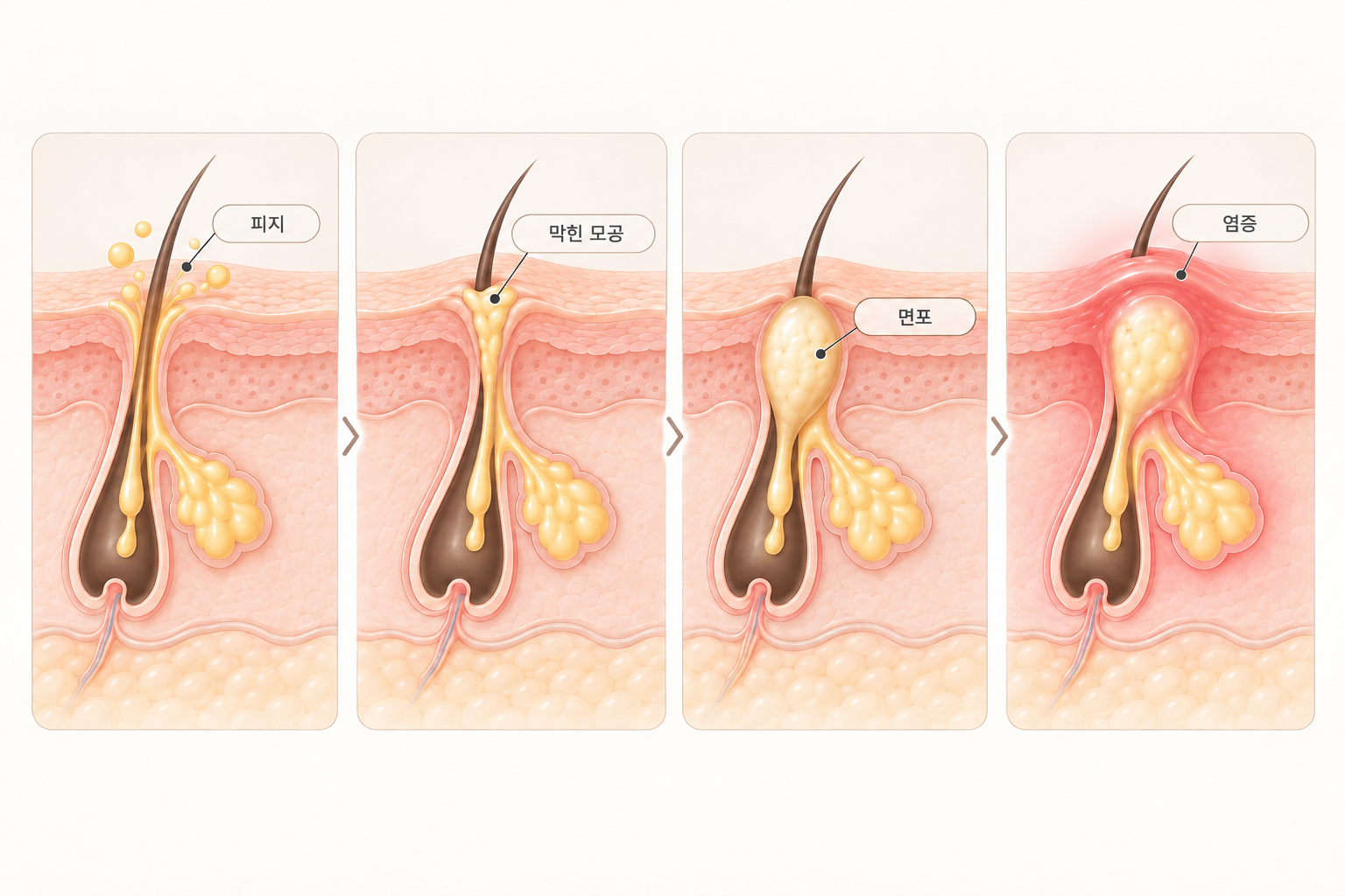 피지 분비 증가부터 모공 막힘과 면포, 염증으로 이어지는 여드름 발생 과정