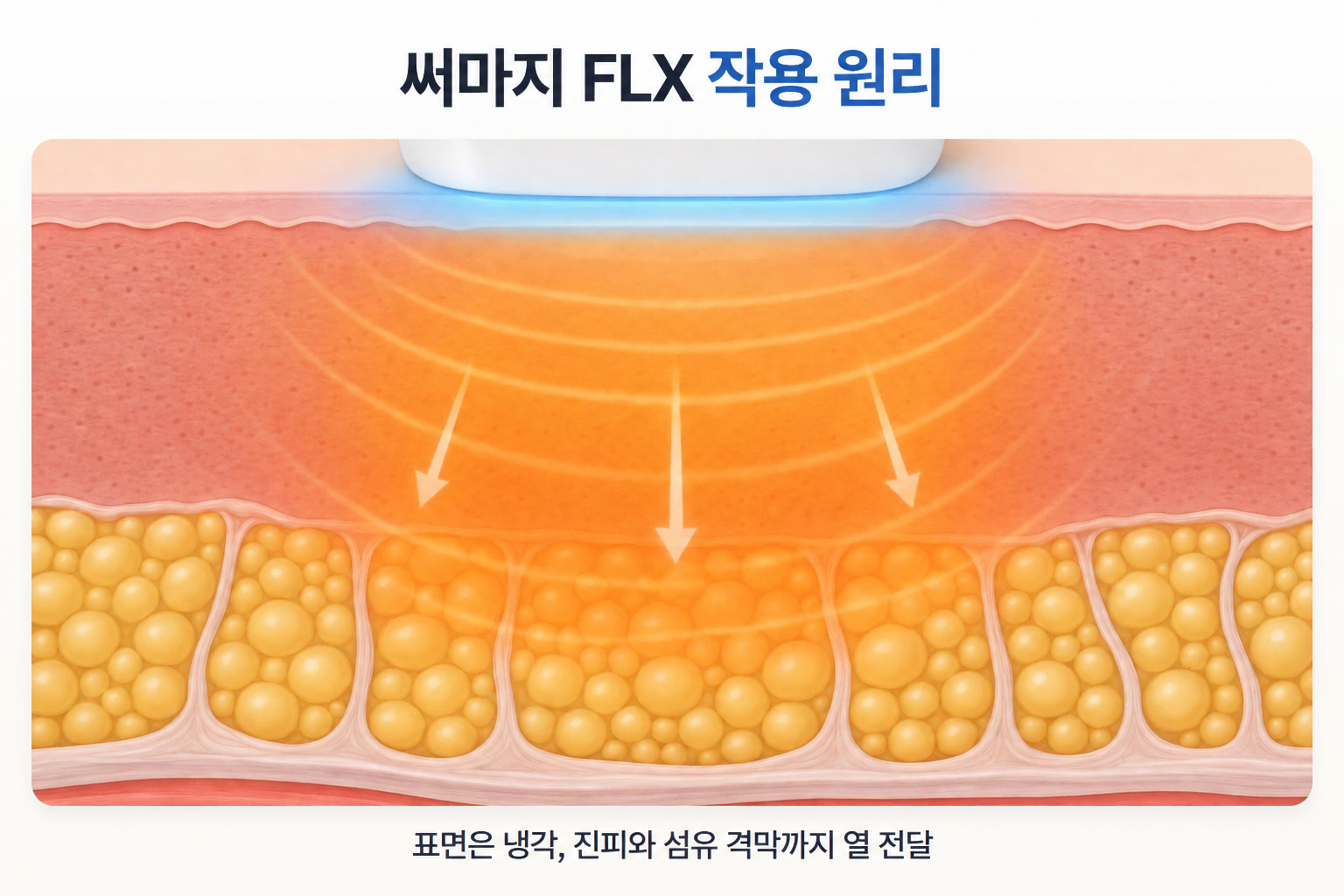 써마지 FLX 고주파 열이 진피와 섬유 격막까지 전달되고 피부 표면은 냉각되는 원리