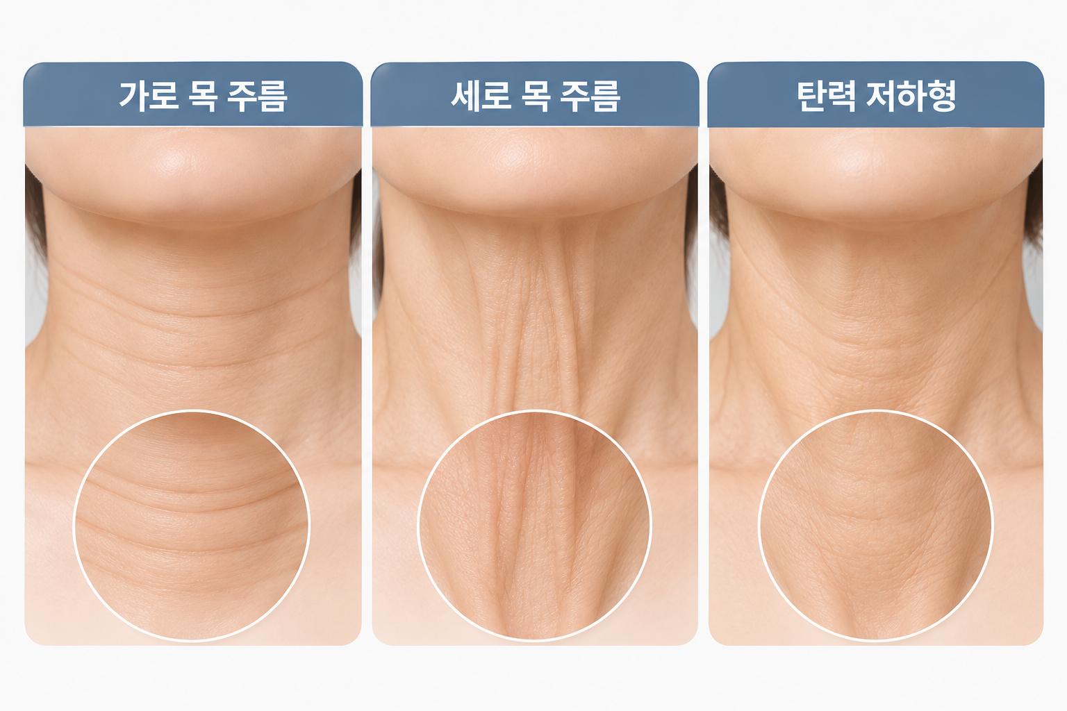 가로 목주름, 세로 목주름, 탄력 저하형 목주름의 피부 상태와 주름 형태를 비교한 3가지 유형별 인포그래픽