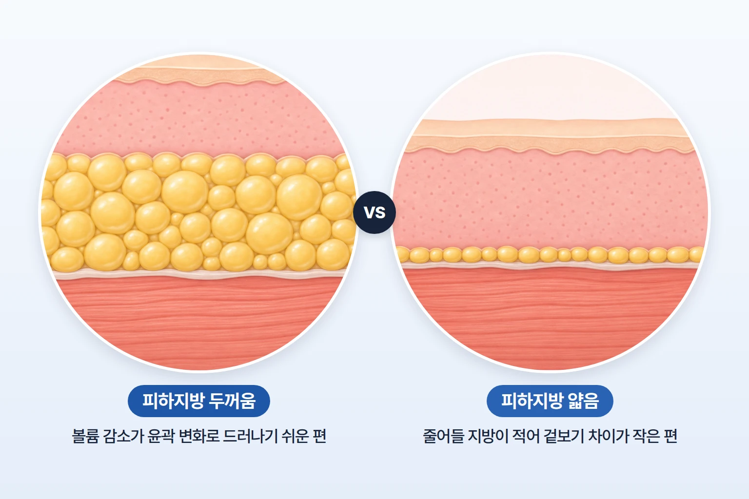 지방이 적은 얼굴이 인모드효과없음을 느끼는 이유