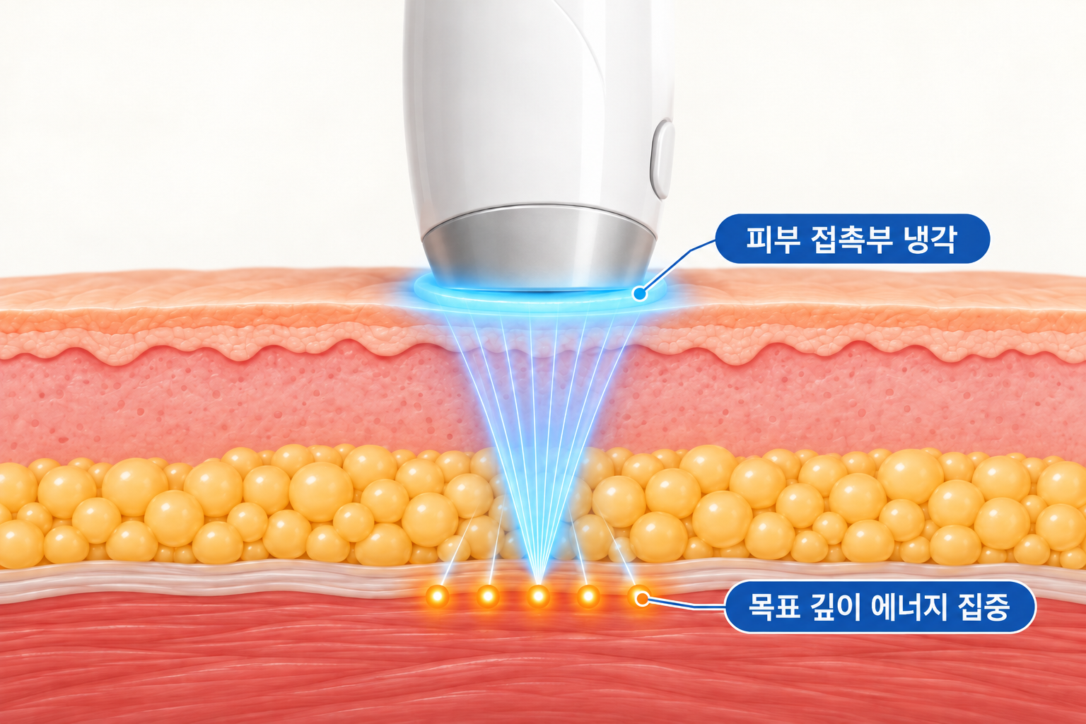 쿨소닉 ACC 냉각 기술과 피부 접촉부 냉각 및 목표 깊이 에너지 집중 구조