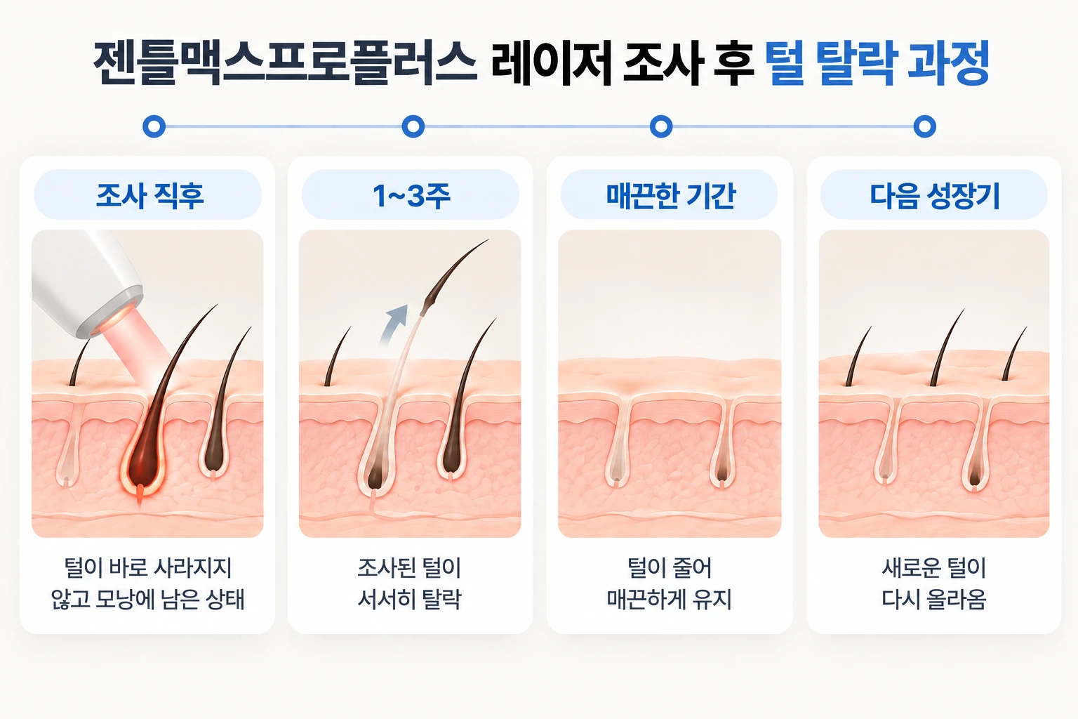 레이저 조사 후 1~3주 털 탈락, 매끈한 기간, 휴지기 털 재성장을 시점별로 정리한 흐름