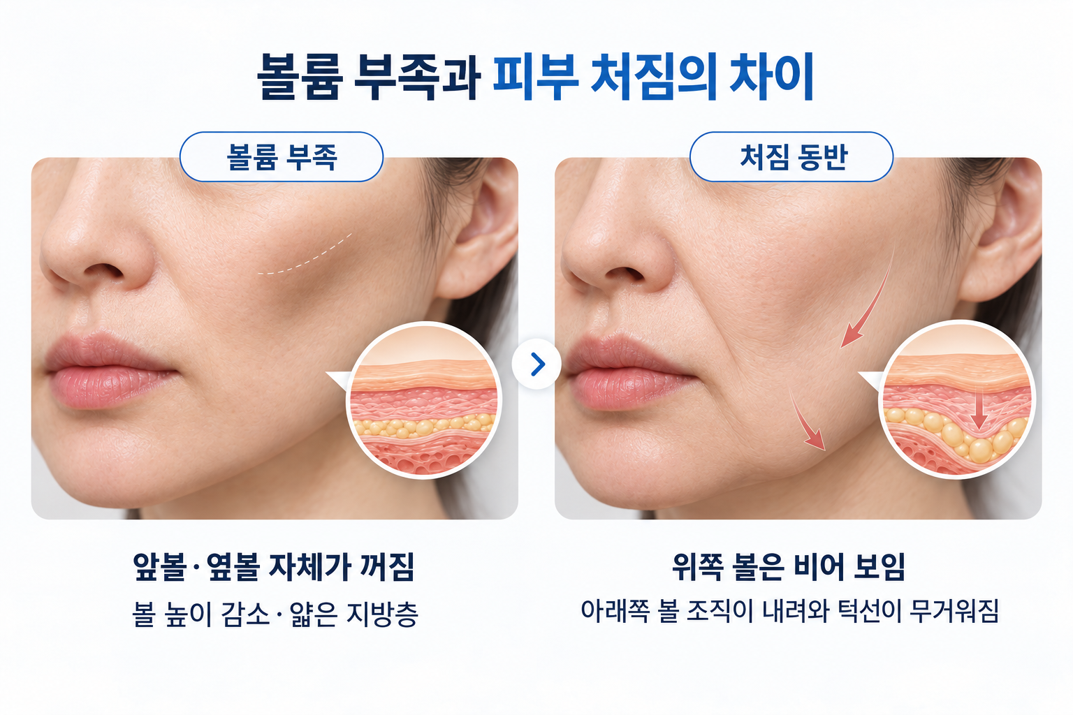앞볼과 옆볼의 볼륨 부족과 아래로 이동한 볼 조직의 피부 처짐 차이