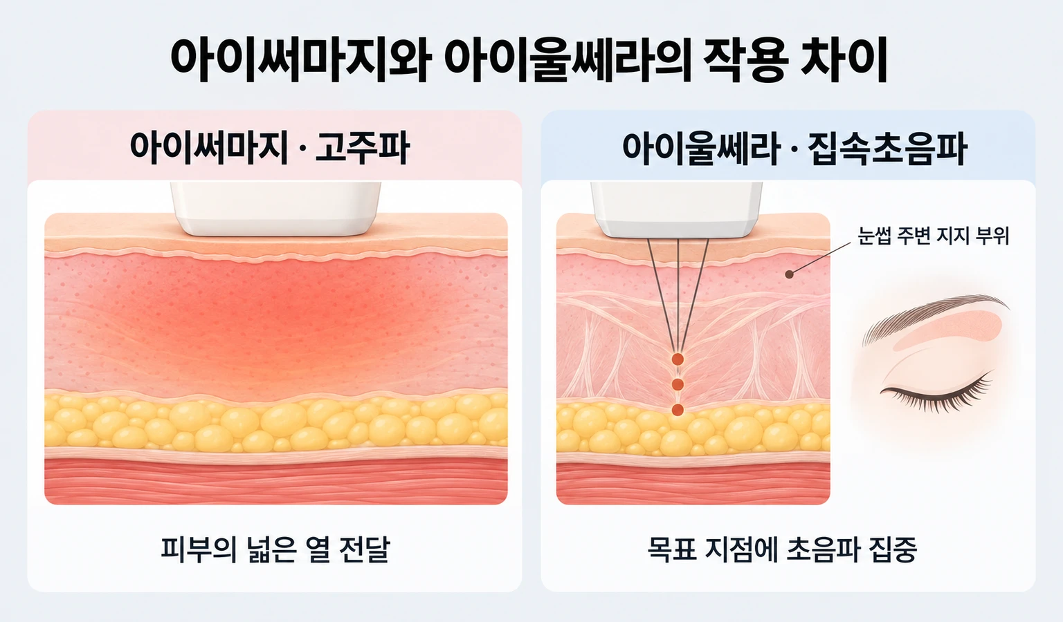 아이써마지의 넓은 고주파 열 전달과 아이울쎄라의 목표 지점 초음파 집중 비교