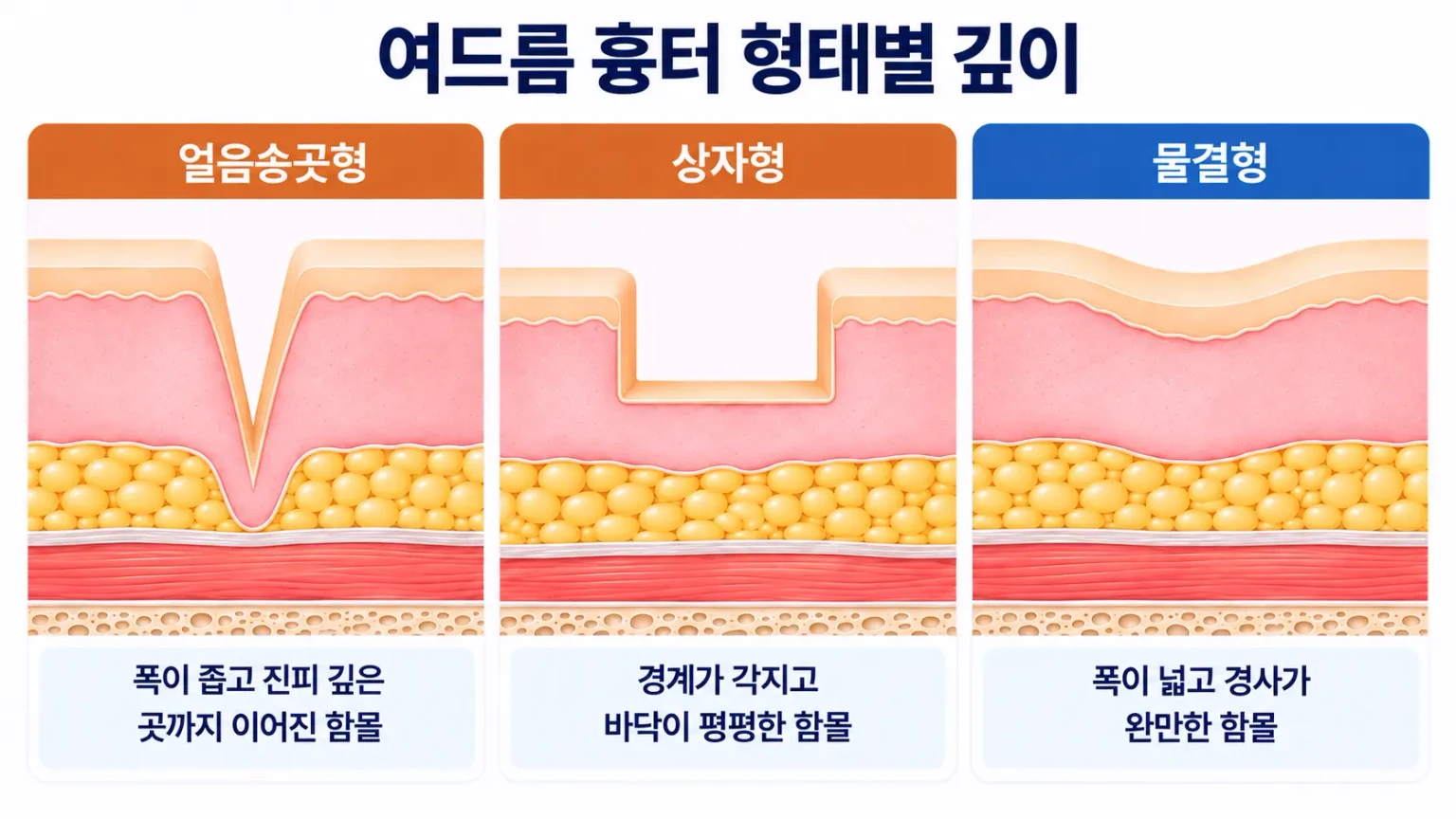 얼음송곳형, 상자형, 물결형 여드름 흉터의 폭과 깊이를 같은 축척으로 비교한 피부 단면 모식도
