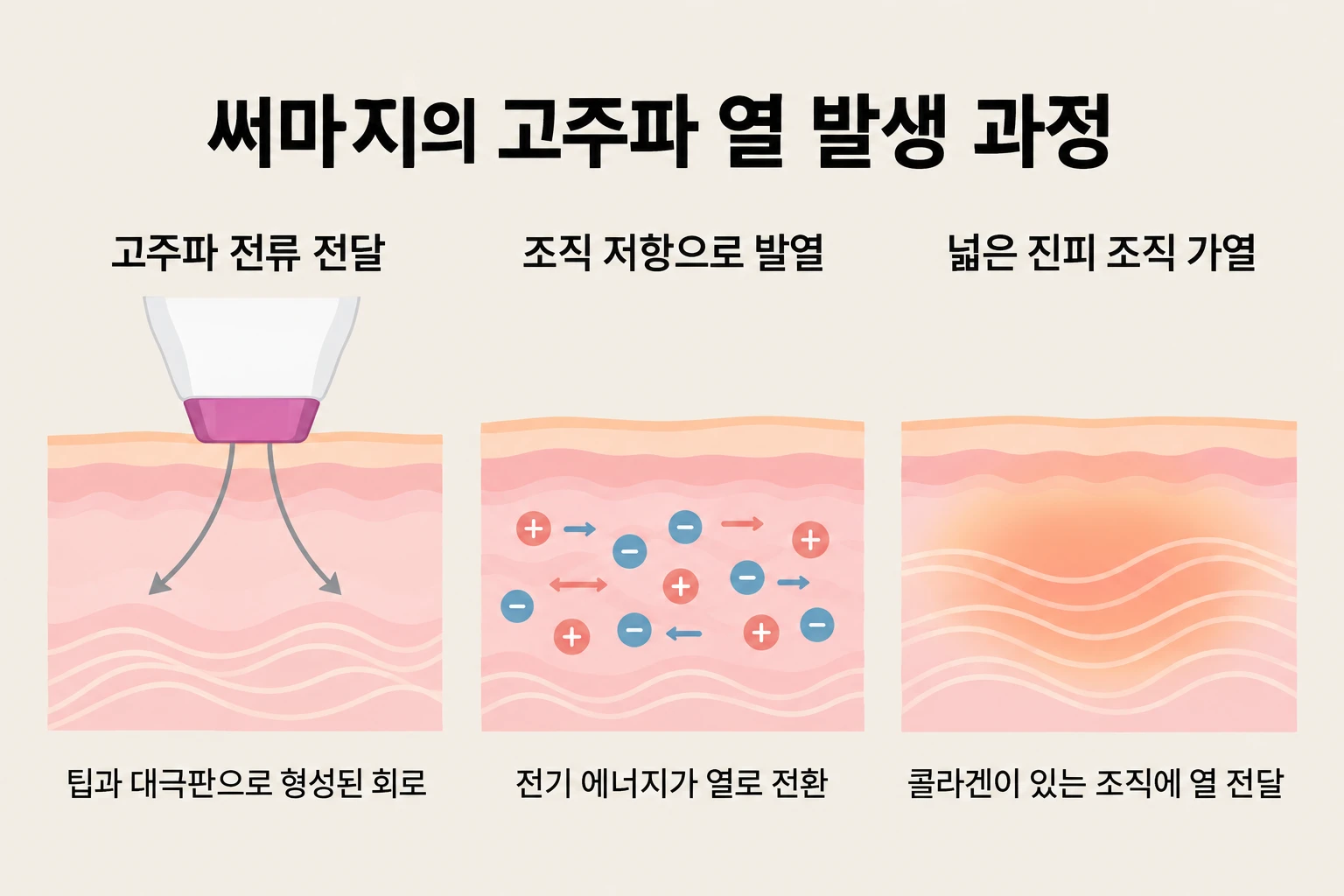 써마지 고주파 전류가 조직 저항을 만나 진피에 열을 만드는 과정 안내