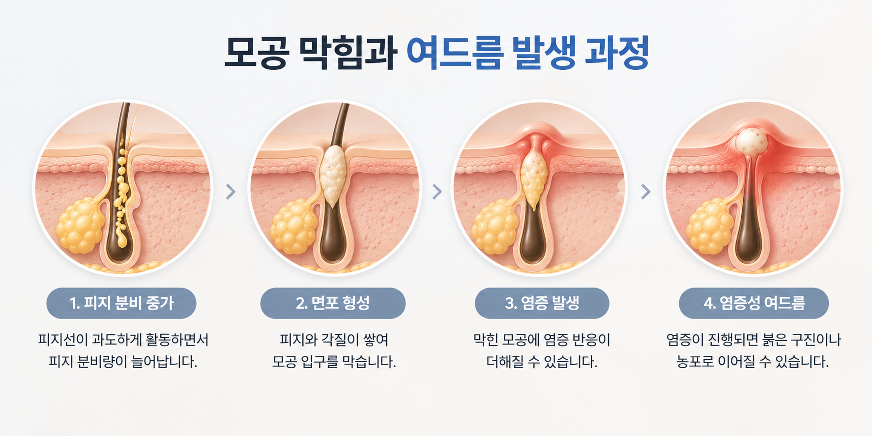 피지 과다와 모공 막힘, 염증성 여드름 발생 과정