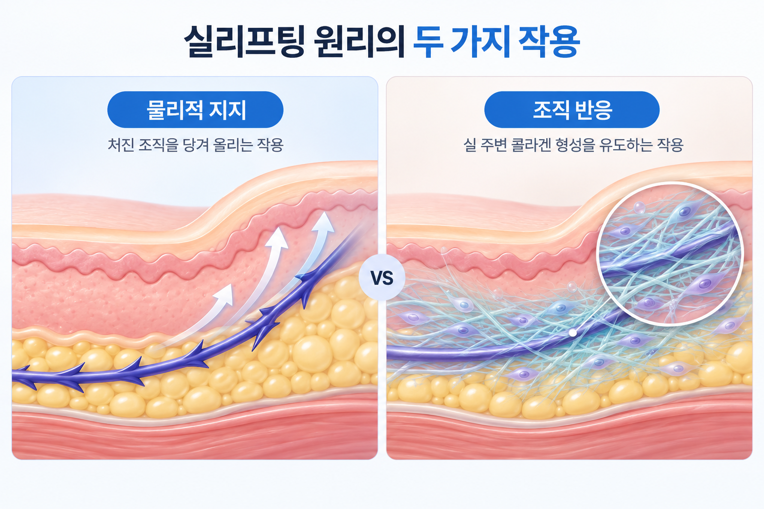 실리프팅 원리의 물리적 지지와 콜라겐 조직 반응 비교
