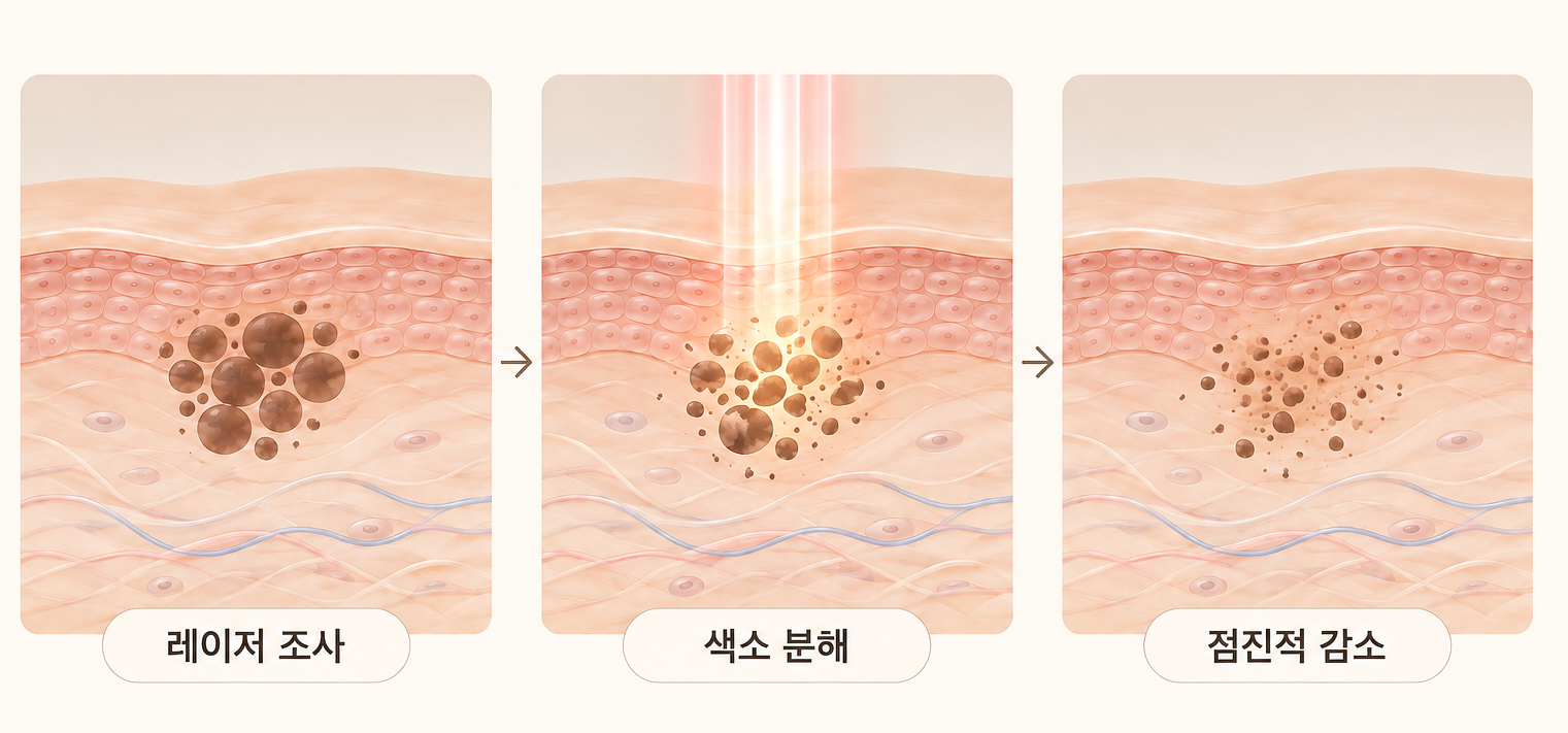 색소침착 레이저 조사 후 멜라닌 색소가 분해되고 점진적으로 감소하는 과정