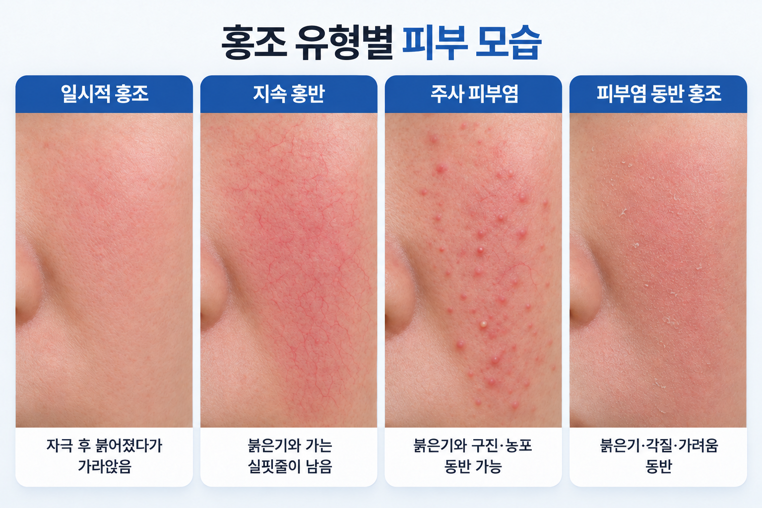 일시적 홍조, 지속 홍반, 주사 피부염, 피부염 동반 홍조의 피부 특징을 비교한 이미지
