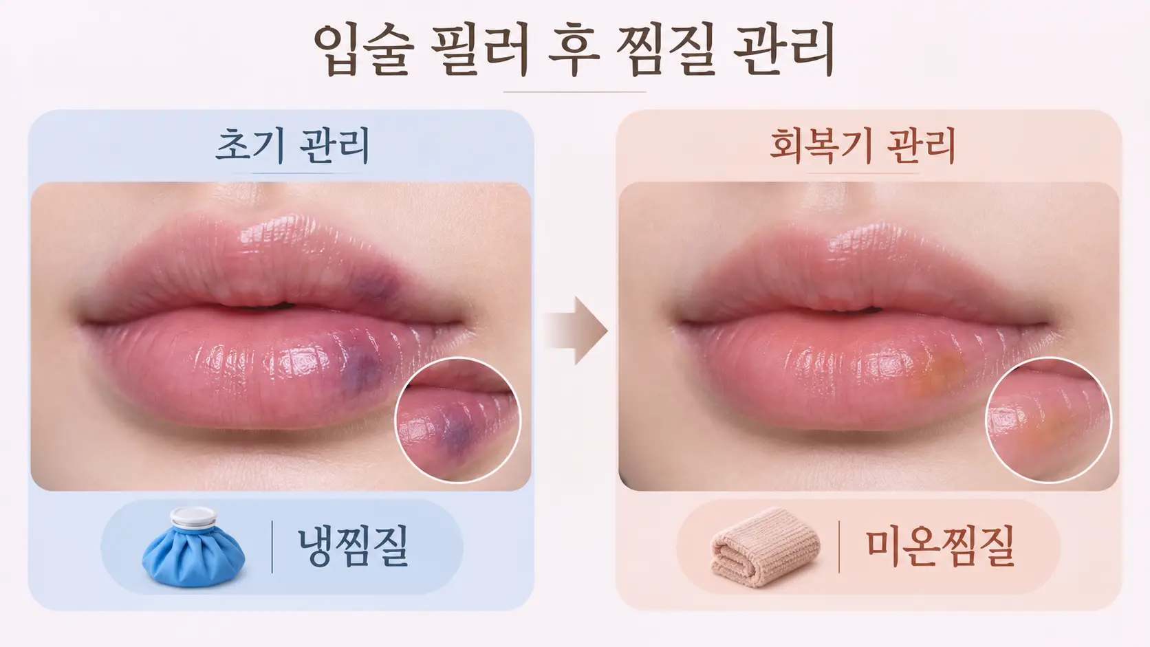 입술필러 후 멍 관리 방법