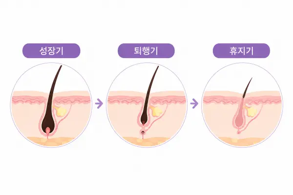 대전 레이저 제모 회차가 필요한 이유를 보여주는 성장기 퇴행기 휴지기 털 성장주기 이미지