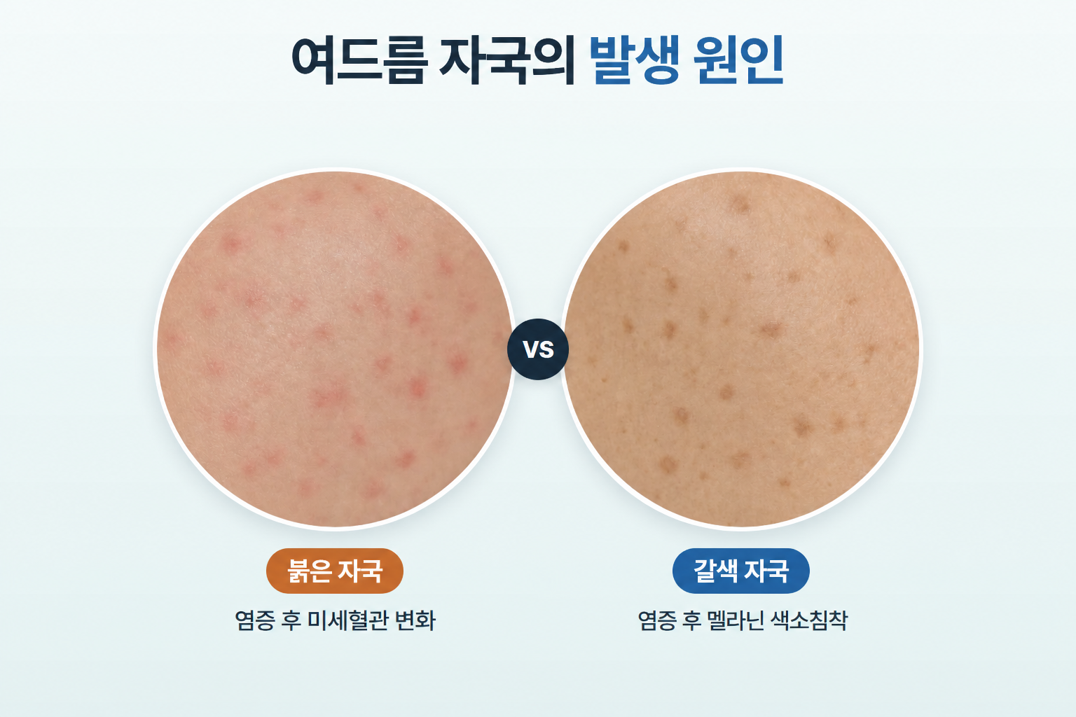 붉은 여드름 자국은 염증 후 미세혈관 변화로 분홍빛을 띠고, 갈색 자국은 멜라닌 색소침착으로 갈색 반점이 남은 피부 상태 비교