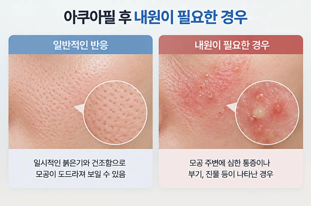 아쿠아필 후 정상적인 반응과 내원이 필요한 경우를 나타내는 이미지 단면도