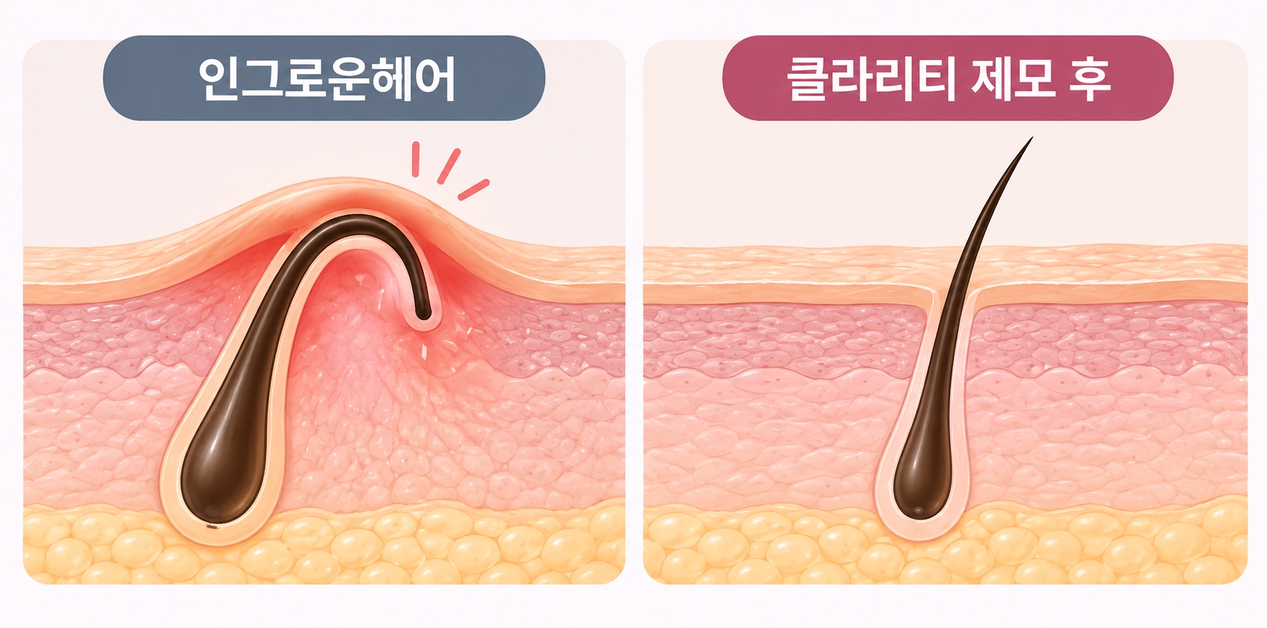피부 안쪽으로 말려 자라는 인그로운헤어와 클라리티 제모 후 모발이 정상적으로 자라는 모습을 비교한 모낭 단면도