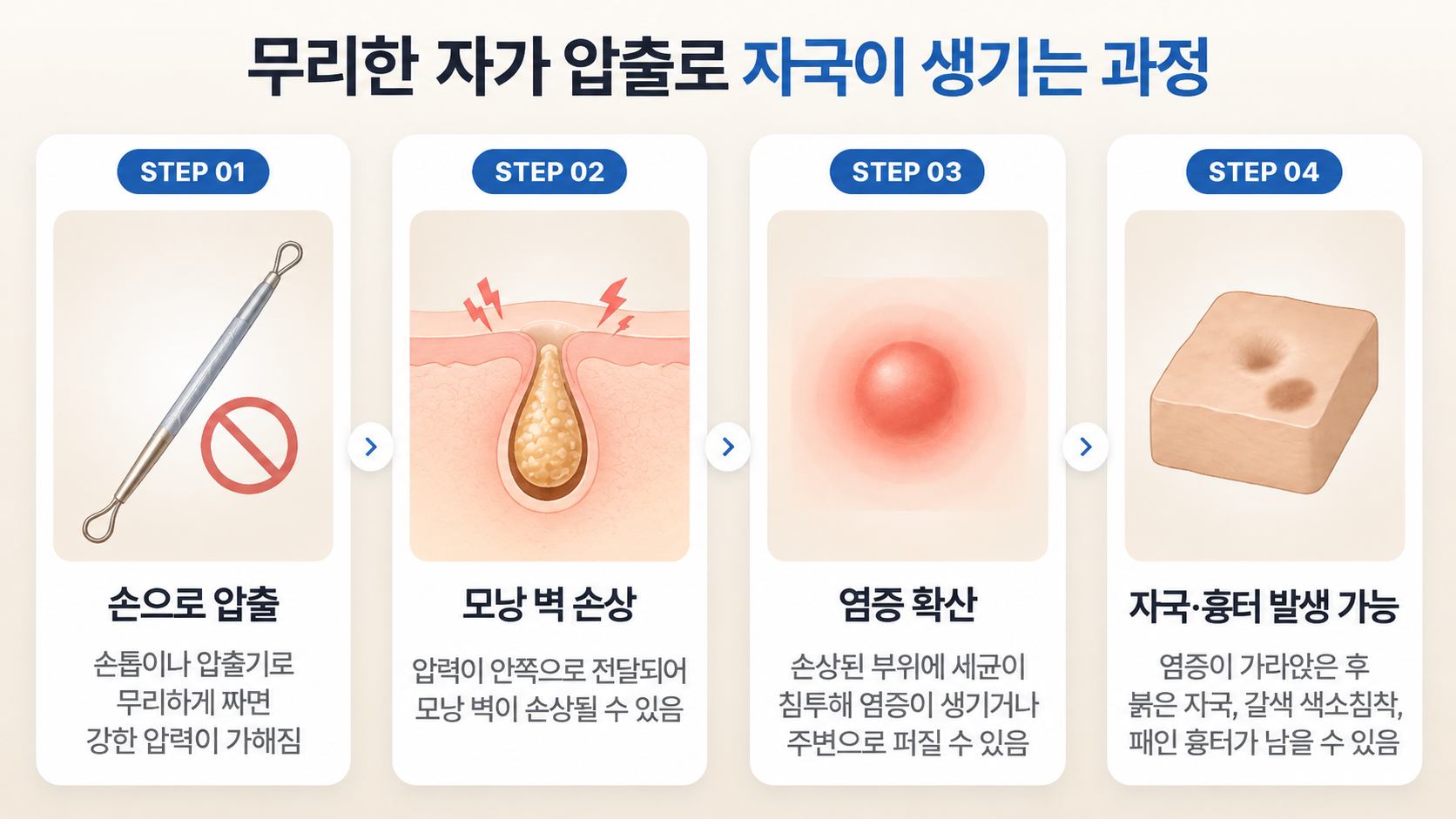 좁쌀여드름을 무리하게 압출할 때 강한 압력으로 모낭 벽이 손상되고 염증이 발생해 붉은 자국과 색소침착, 흉터로 이어질 수 있는 4단계 과정