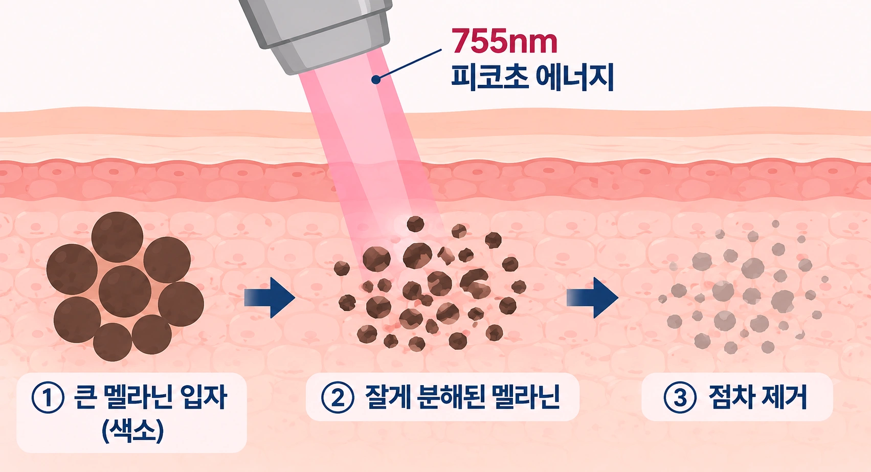 755nm 피코초 레이저 에너지가 멜라닌 색소를 잘게 분해하고 점차 제거되는 과정을 나타낸 피부 단면도