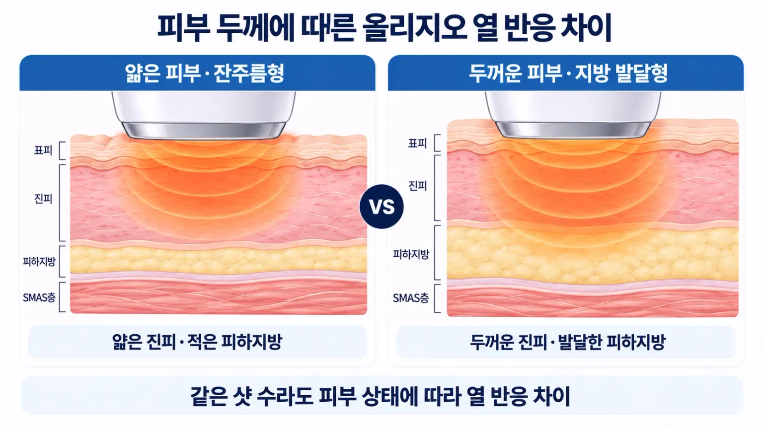 올리지오 고주파 시술 시 얇은 피부와 두꺼운 피부의 진피층 및 피하지방 두께에 따른 열에너지
