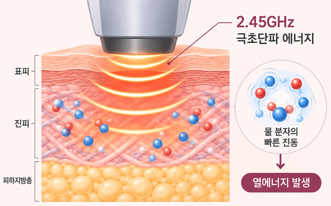 온다 레이저 2.45GHz 극초단파 에너지가 피부 조직에 열을 발생시키는 원리를 나타낸 모식도