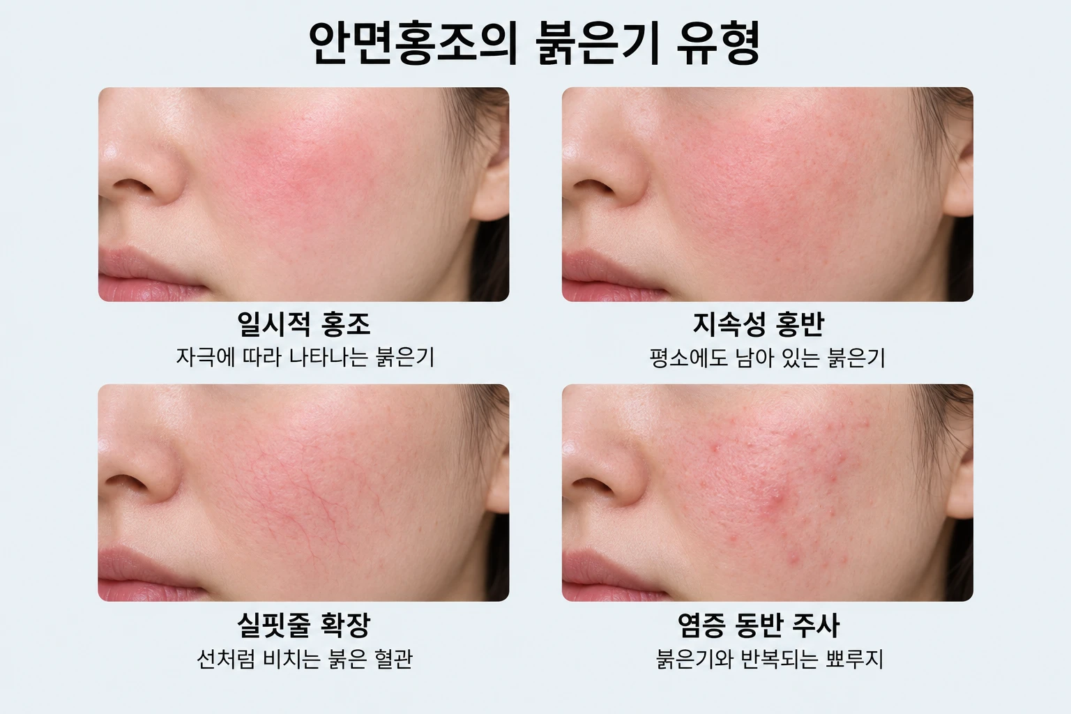 일시적 홍조와 지속성 붉은기·실핏줄·염증 동반 주사의 차이