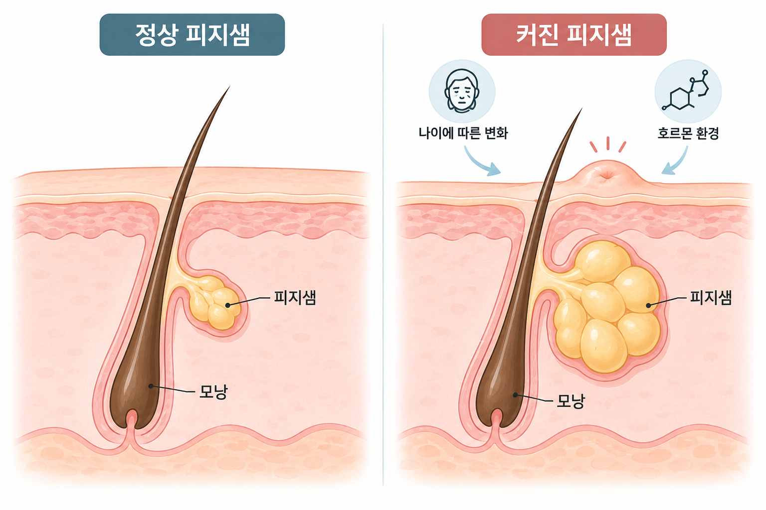 정상 피지샘과 피지선증식증에서 커진 피지샘의 피부 단면 비교