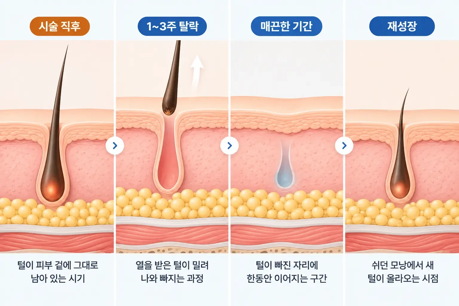 레이저 조사 뒤 털 탈락, 매끈한 기간, 휴지기 털 재성장을 시간순으로 나타낸 모낭 단면 흐름