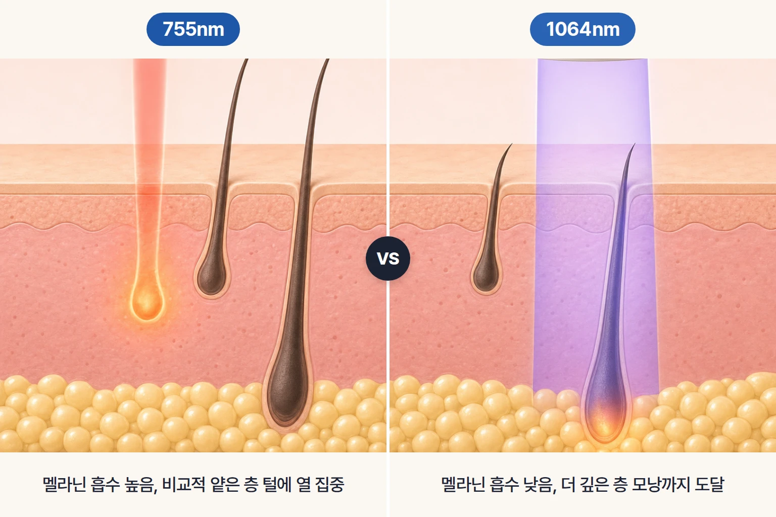 755nm와 1064nm 빛이 표피를 지나 얕은 모낭과 깊은 모낭에 닿는 깊이를 비교한 피부 단면도