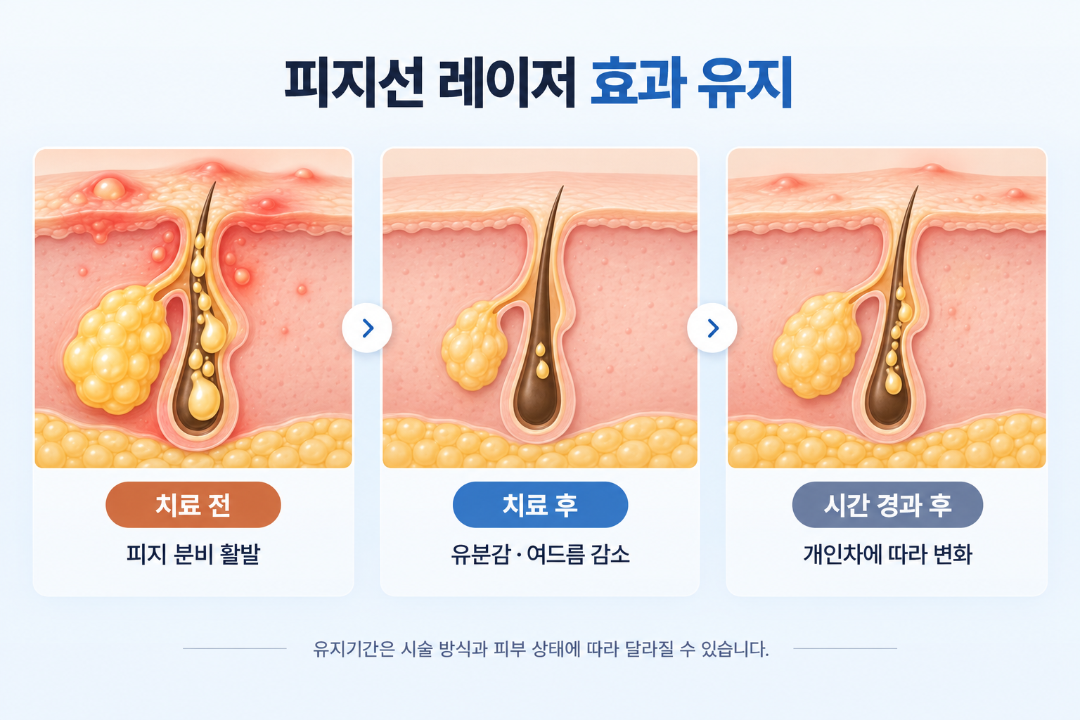 피지선 레이저 치료 후 피지 분비와 여드름의 변화
