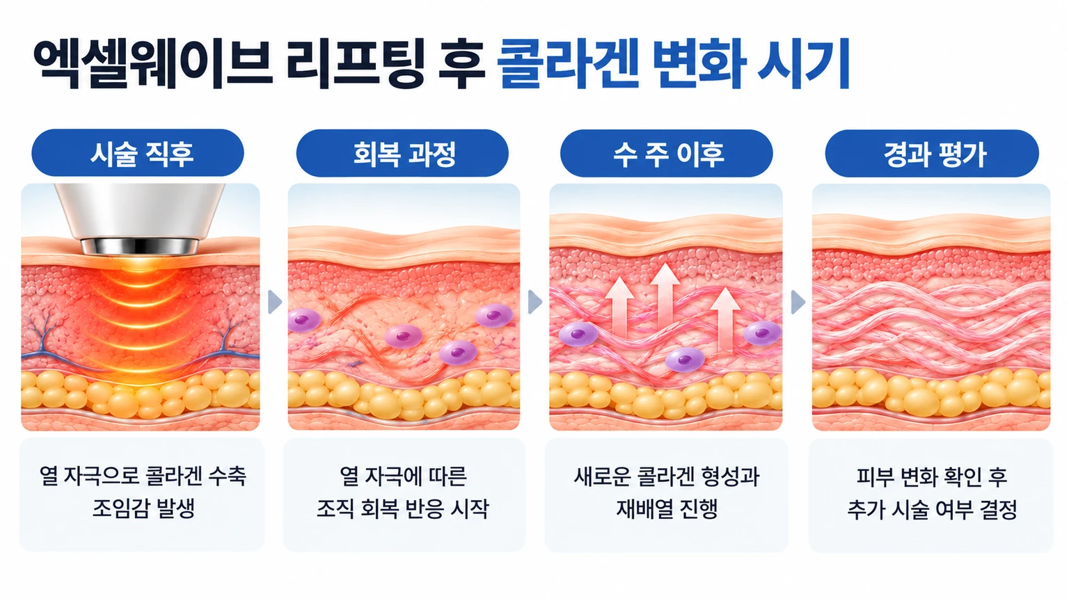 시술 직후 콜라겐 수축부터 수 주 이후 새 콜라겐 형성까지 시기별 진피 변화를 정리한 흐름 이미지