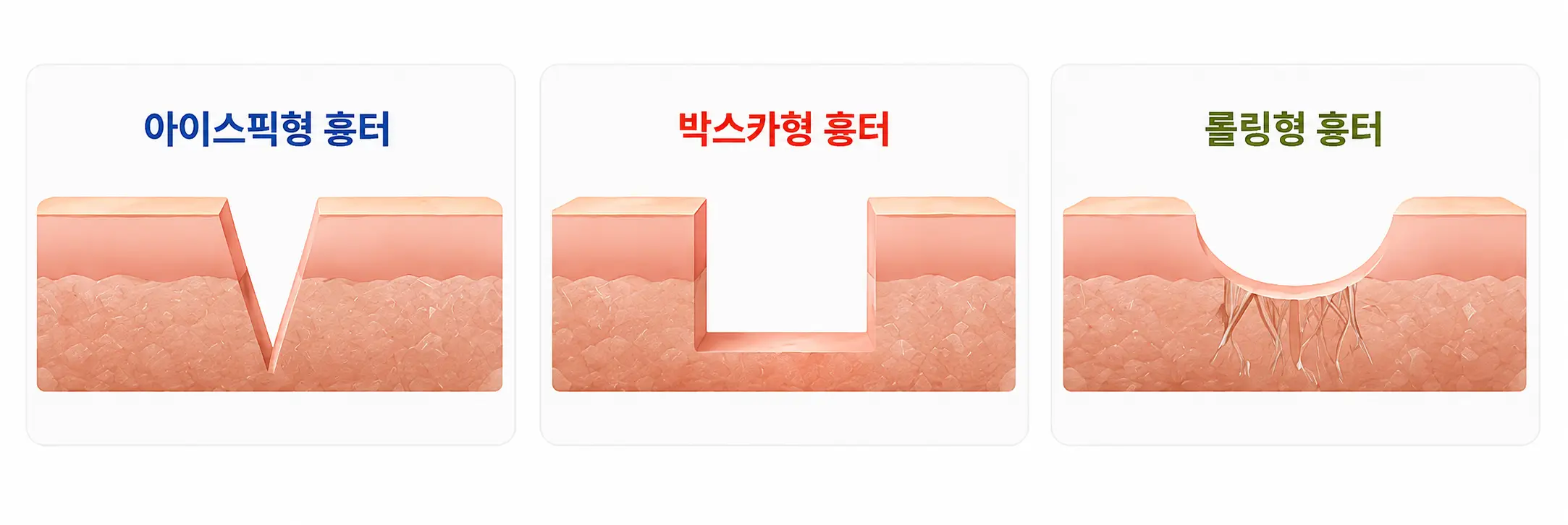 여드름 흉터 유형별 피부 표면의 차이