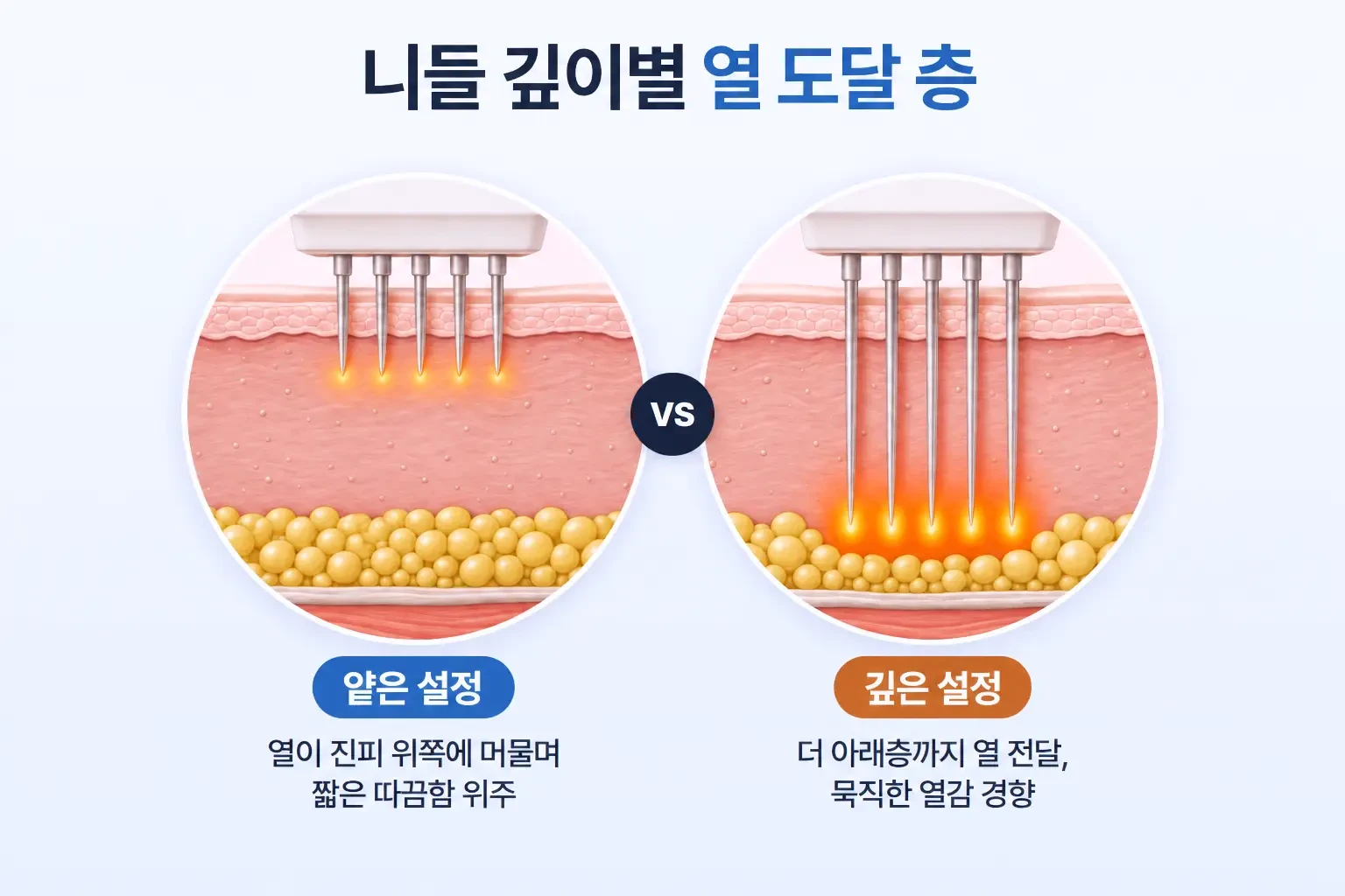 포텐자 니들 깊이를 얕게 또는 깊게 설정했을 때 열이 닿는 층을 나란히 비교한 피부 단면도