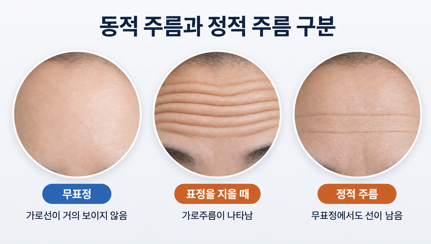 무표정과 표정을 지을 때 나타나는 동적 주름과 정적 주름 차이