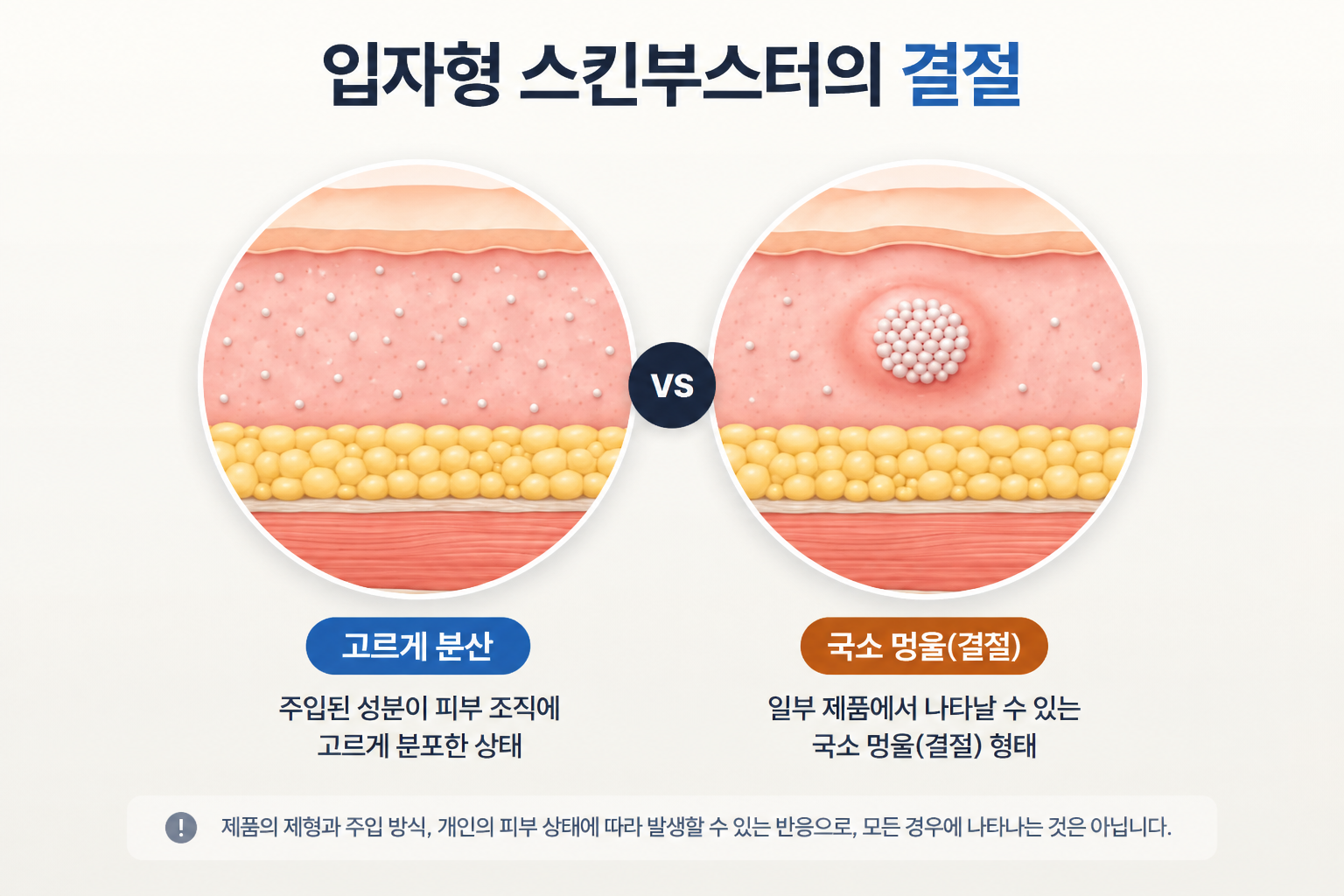 입자형 스킨부스터 성분이 피부 조직에 고르게 분포한 상태와 국소적으로 멍울이 형성된 상태를 비교한 피부 단면 구조