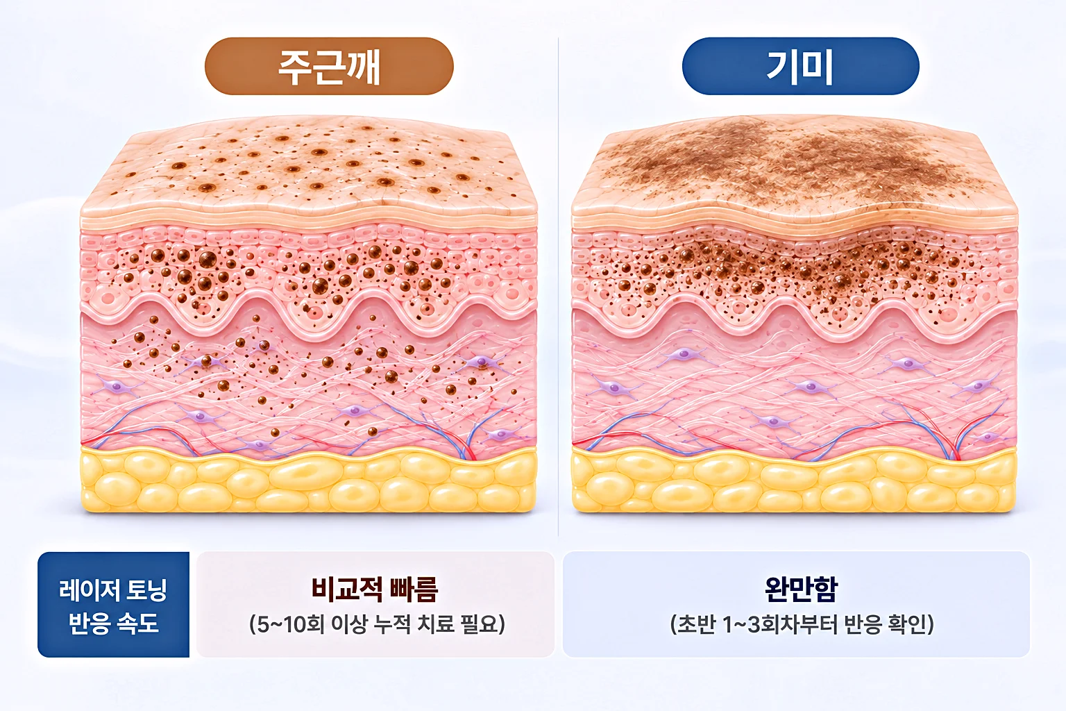 주근깨와 기미 피부 단면도와 레이저 토닝으로 인한 반응 속도 차이 비교