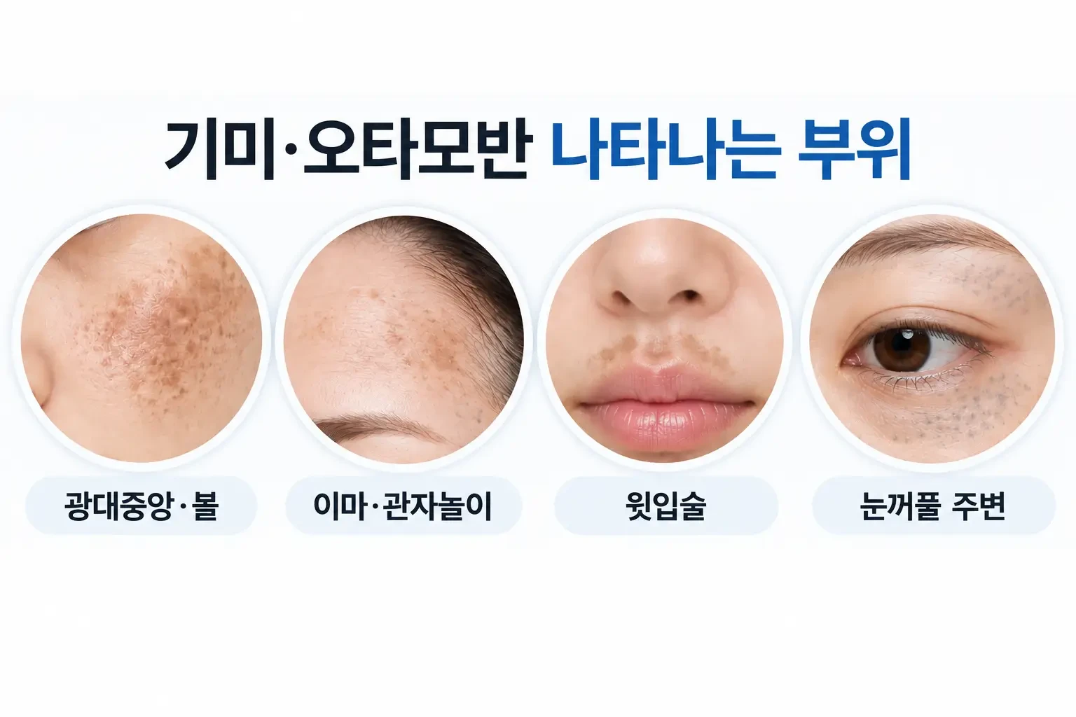 기미가 잘 생기는 광대·이마·윗입술과 오타모반의 눈 주변·관자놀이를 정리한 카드 이미지
