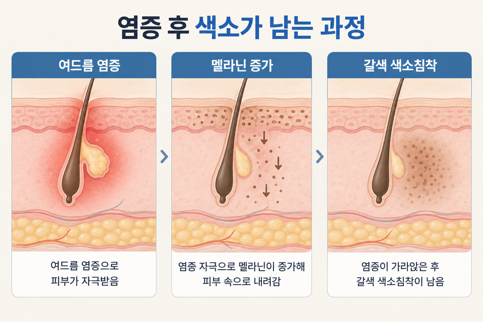 여드름 염증 후 멜라닌이 증가해 갈색 색소침착이 남는 과정