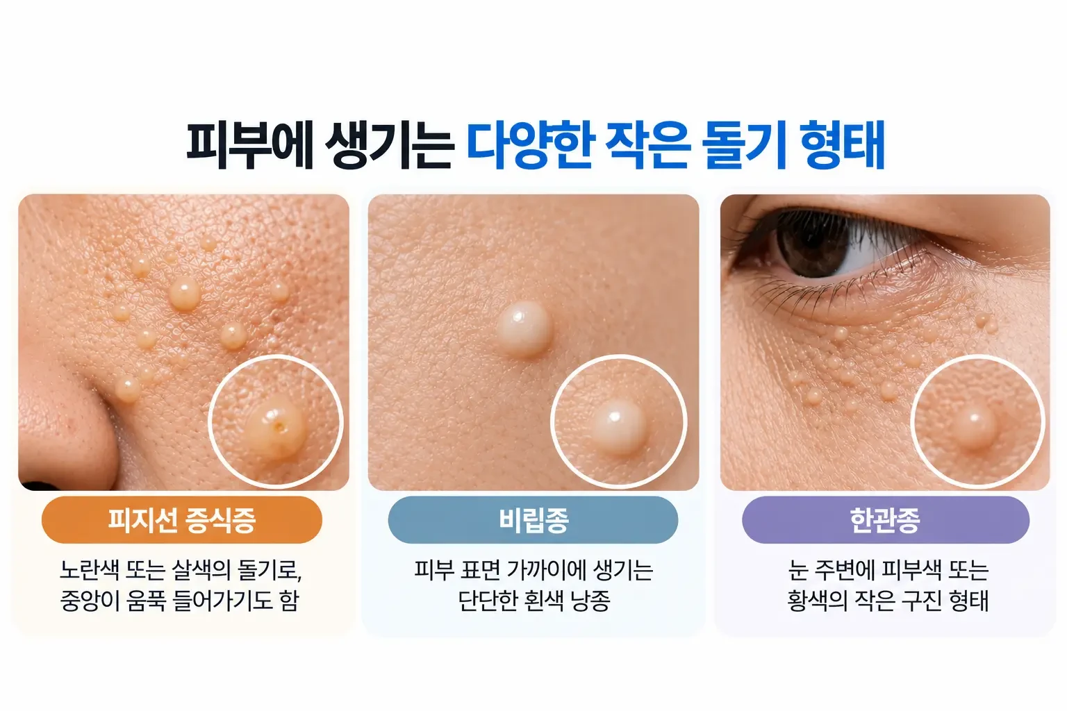 피지선 제거-전 피지선 증식증 비립종 한관종의 피부 돌기 특징과 조직 구조 비교 이미지
