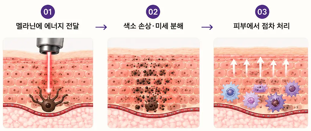 레이저 에너지가 멜라닌을 분해하고 피부에서 처리되는 원리
