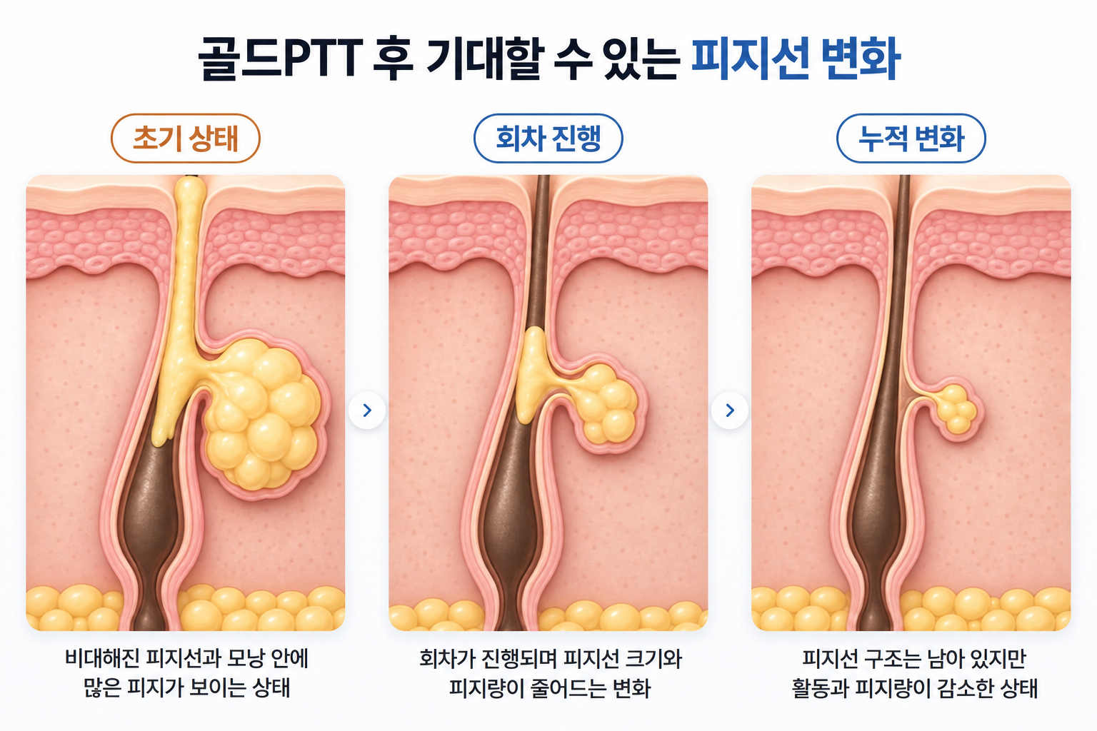 골드PTT 후 비대했던 피지선의 크기와 피지량이 점차 감소하는 변화