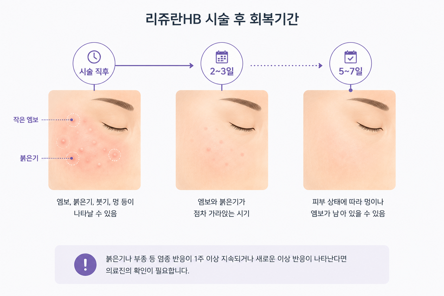 리쥬란HB 시술 직후부터 2~3일, 5~7일까지 엠보와 붉은기가 가라앉는 회복 과정