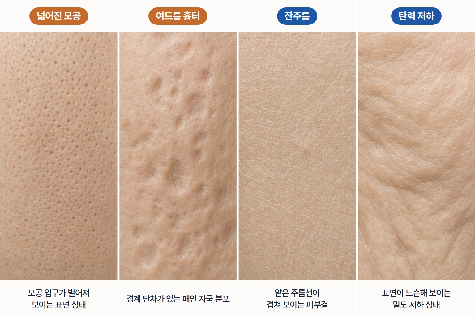 넓어진 모공, 여드름 흉터, 잔주름, 탄력 저하 피부를 같은 배율로 비교한 확대 사진