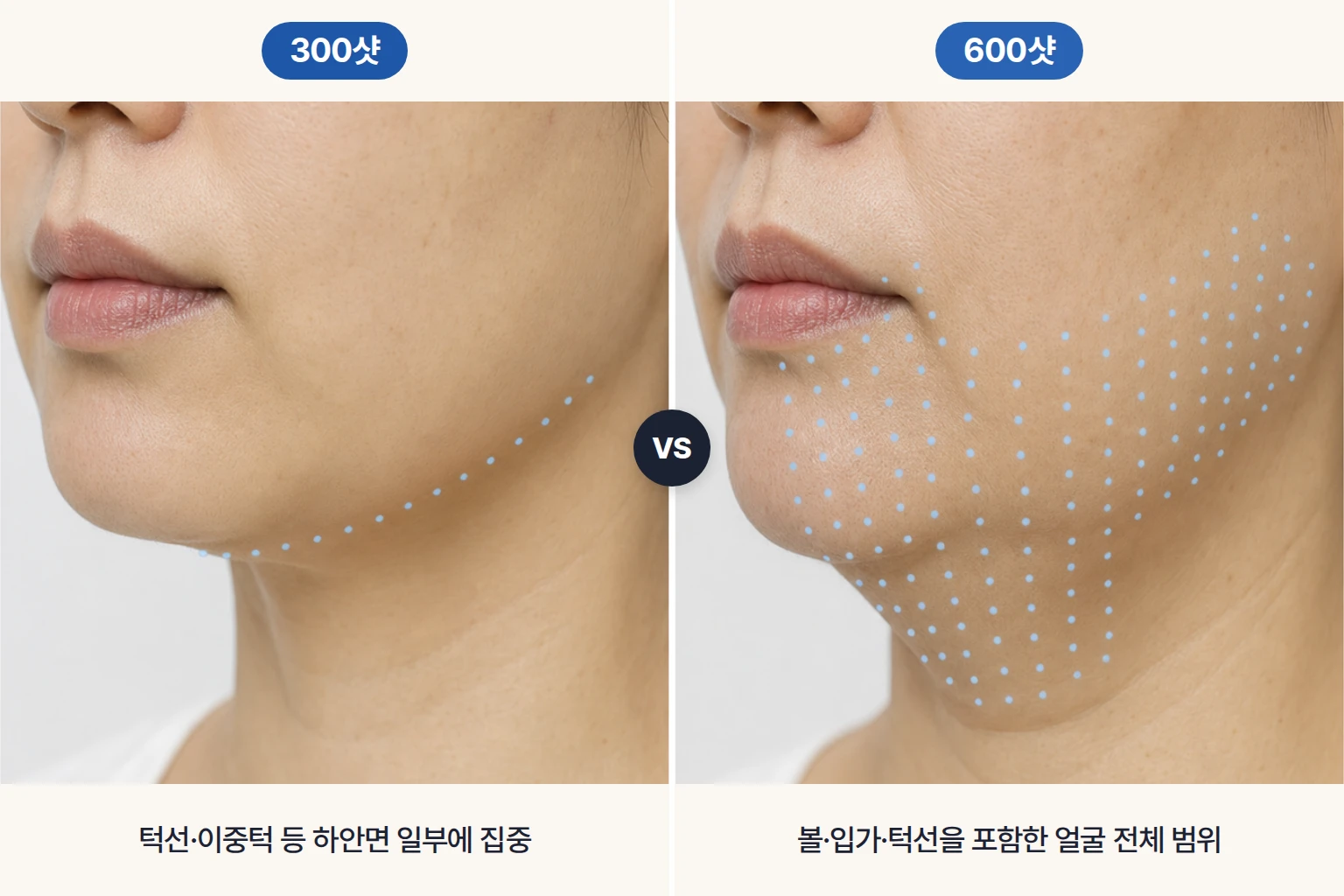 턱선·이중턱 중심 300샷과 볼까지 넓힌 600샷의 조사 범위를 점 배치로 나타낸 얼굴 비교 사진