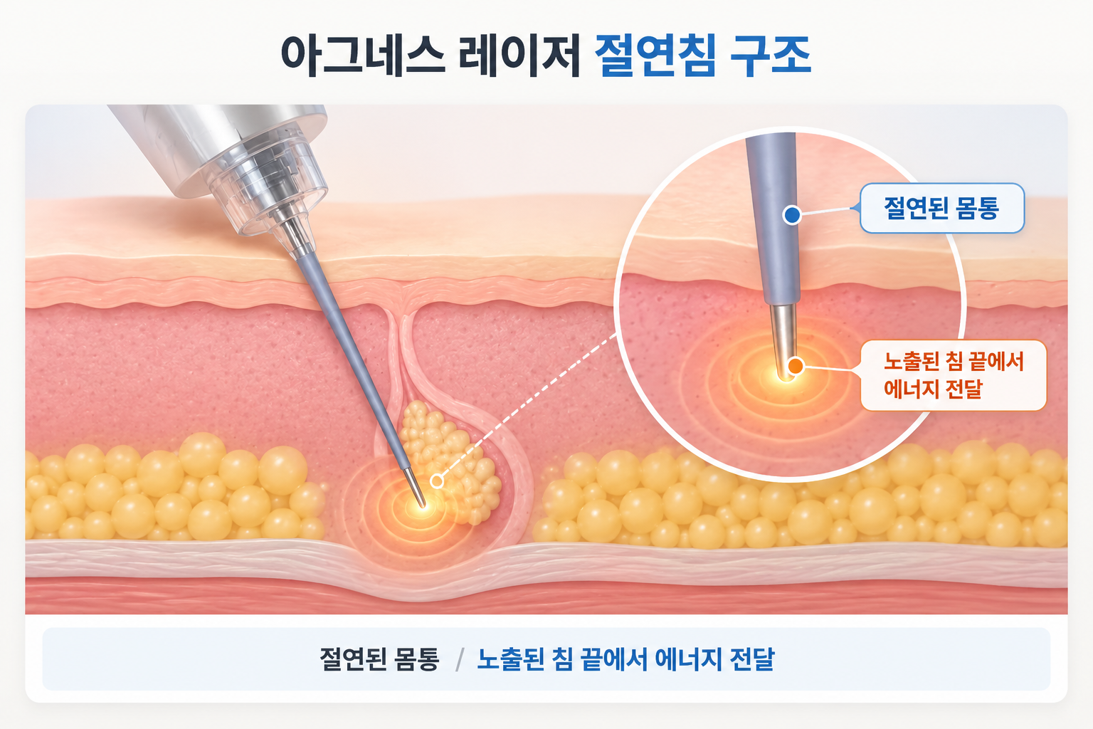 아그네스 레이저 절연된 침 몸통과 노출된 침 끝의 고주파 전달 구조