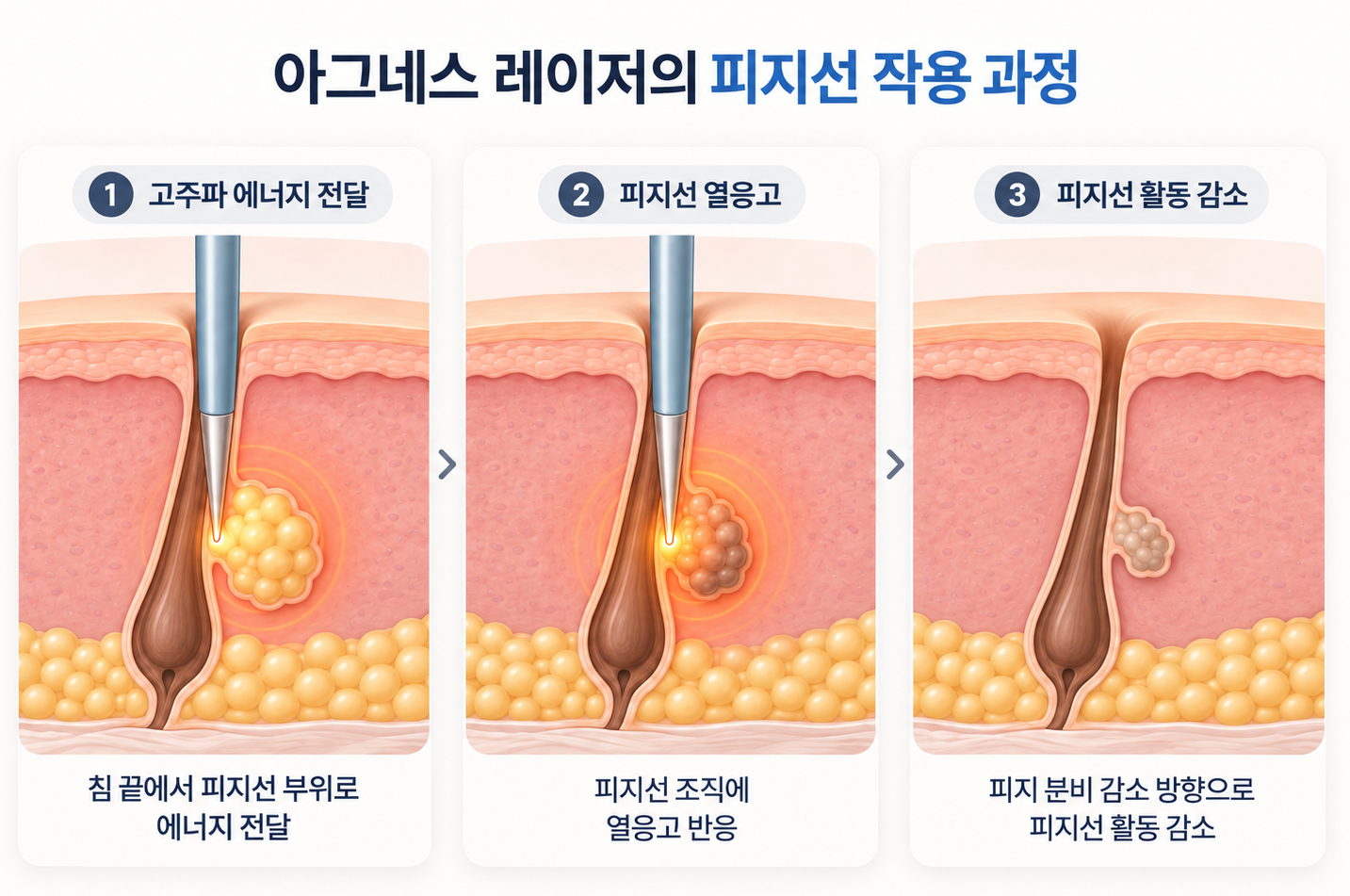 고주파 에너지 전달부터 피지선 열응고와 활동 감소까지의 작용 과정