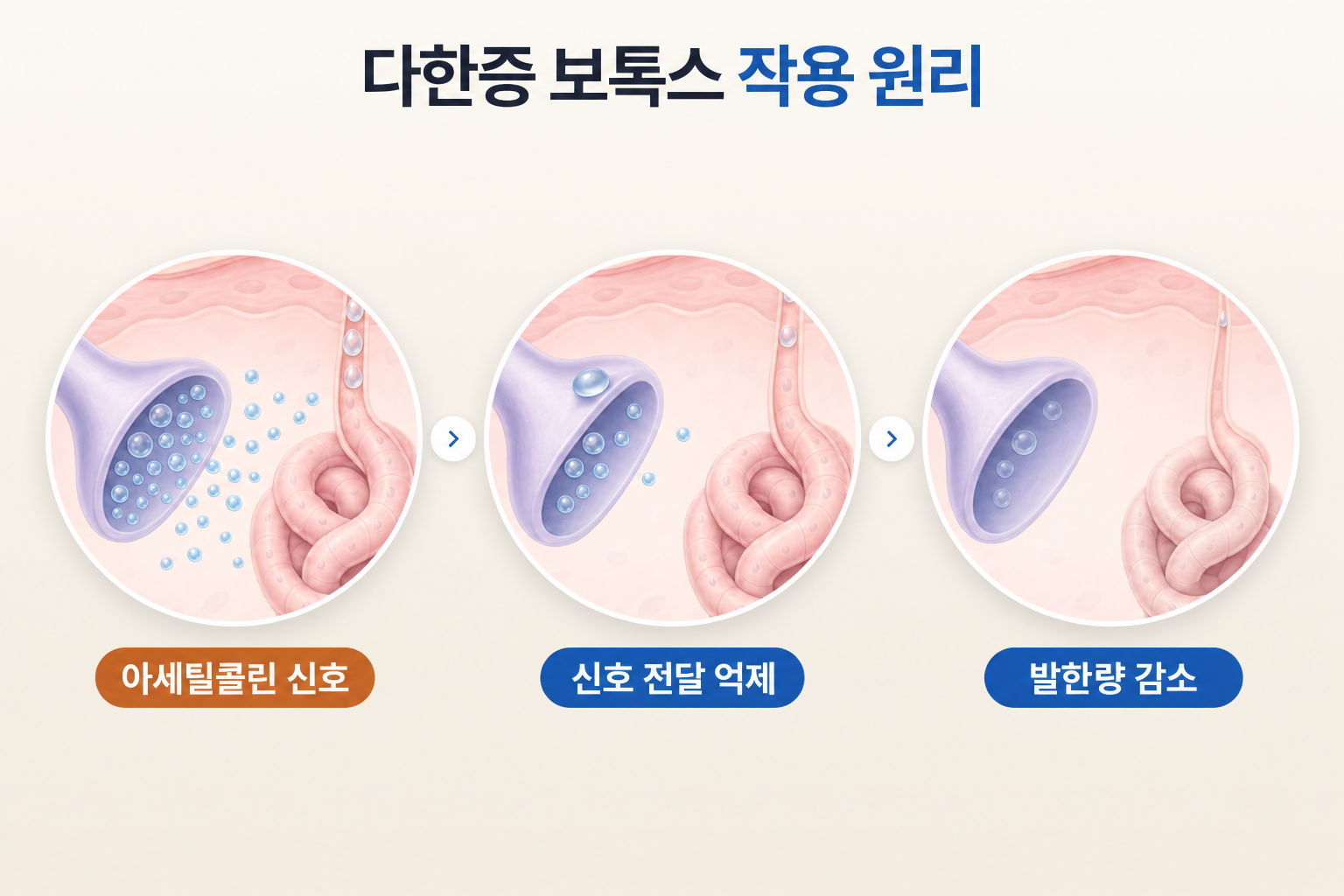 다한증 보톡스의 아세틸콜린 신호 억제와 발한량 감소 과정