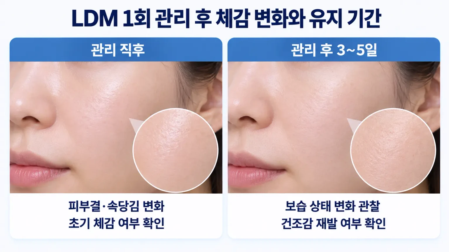 LDM 1회 관리 후 피부결과 속당김 변화 및 보습 유지 기간 비교