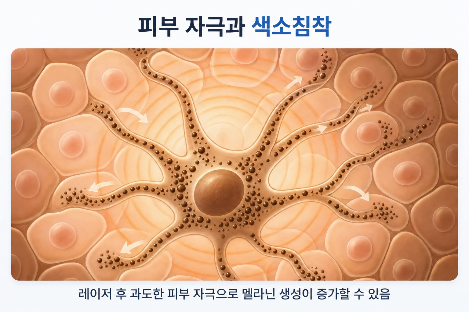 잡티 제거 레이저 후 과도한 피부 자극으로 멜라닌세포의 색소 생성이 증가하고 주변 피부세포로 색소가 전달되는 과정