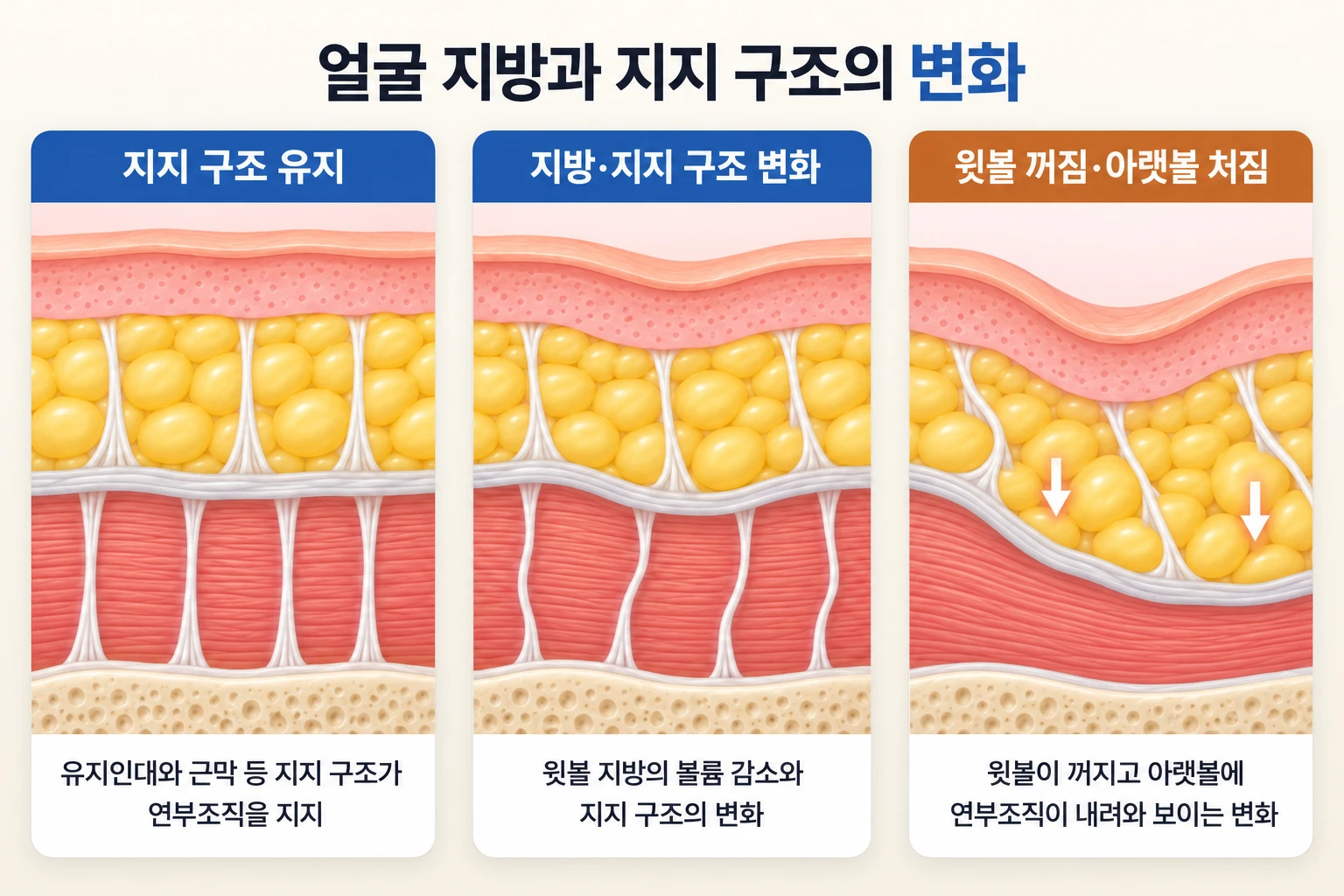 윗볼 지방의 볼륨 감소와 유지인대·근막 등 지지 구조 변화에 따른 아랫볼 연부조직의 하강