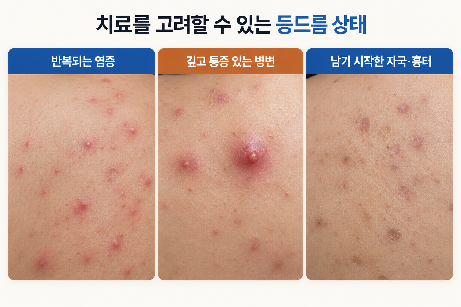 등드름 치료를 고려할 수 있는 반복 염증 깊은 병변 자국 흉터 상태